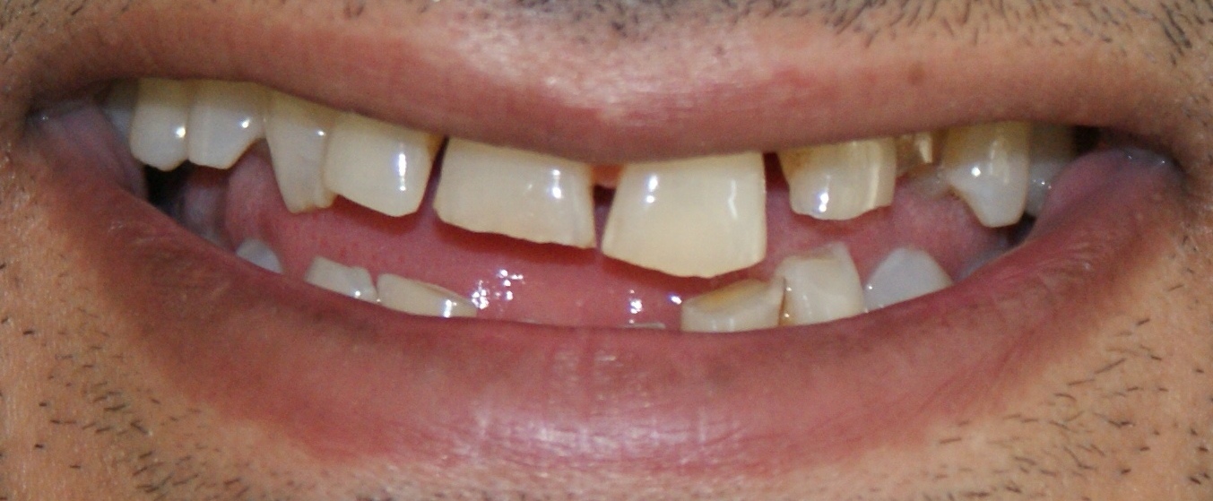 Smile Designing Click To watch video