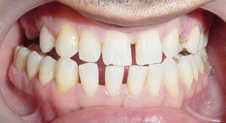 Spacing in teeth 