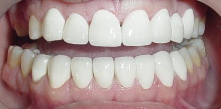 done hollywood smile designing & permanent teeth whitening