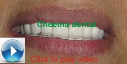 Done hollywood Smile designing click to watch video